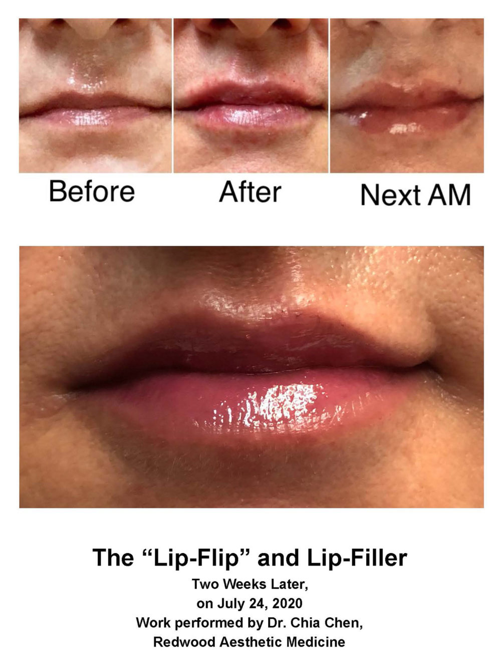 Lips Redwood Aesthetic Medicine